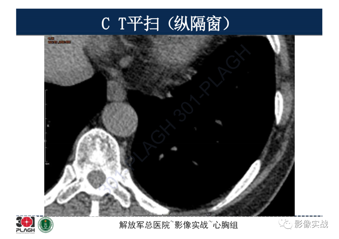 影像PPT - 【病例】肺浸润性腺癌1例CT影像-11