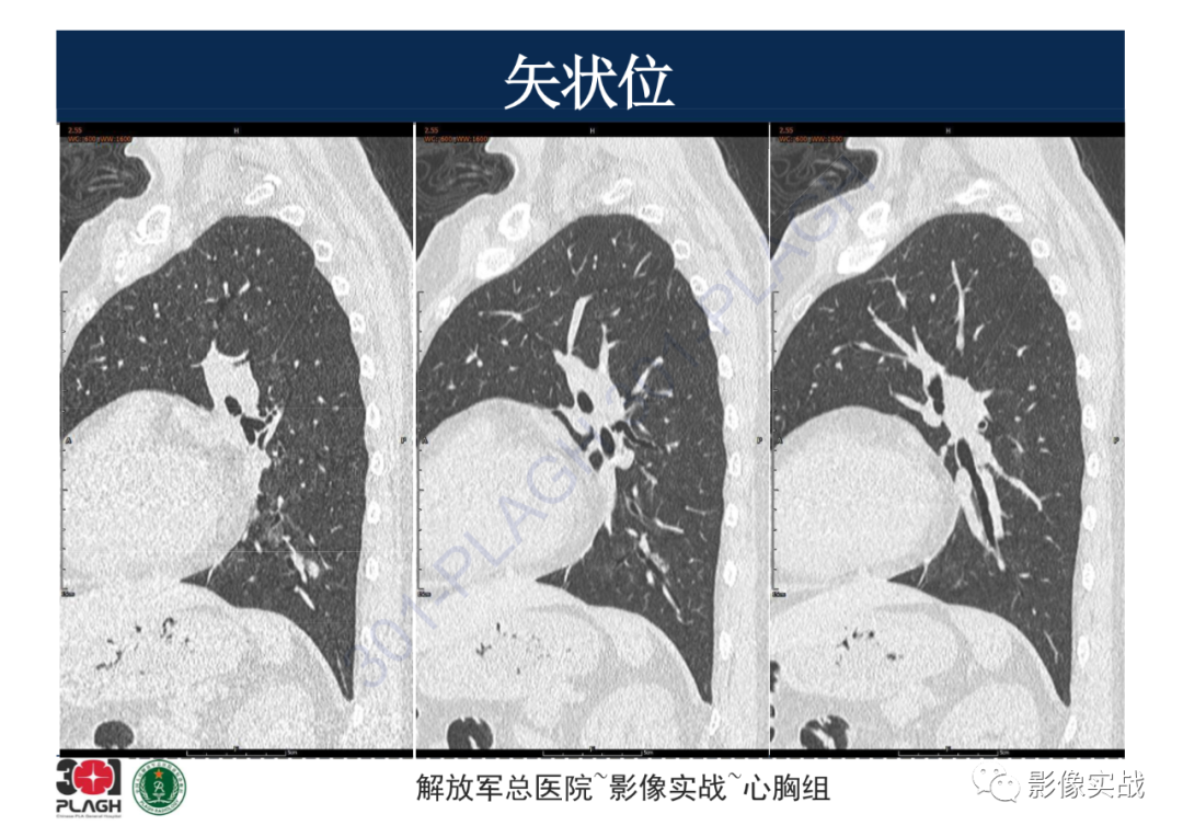 影像PPT - 【病例】肺浸润性腺癌1例CT影像-16
