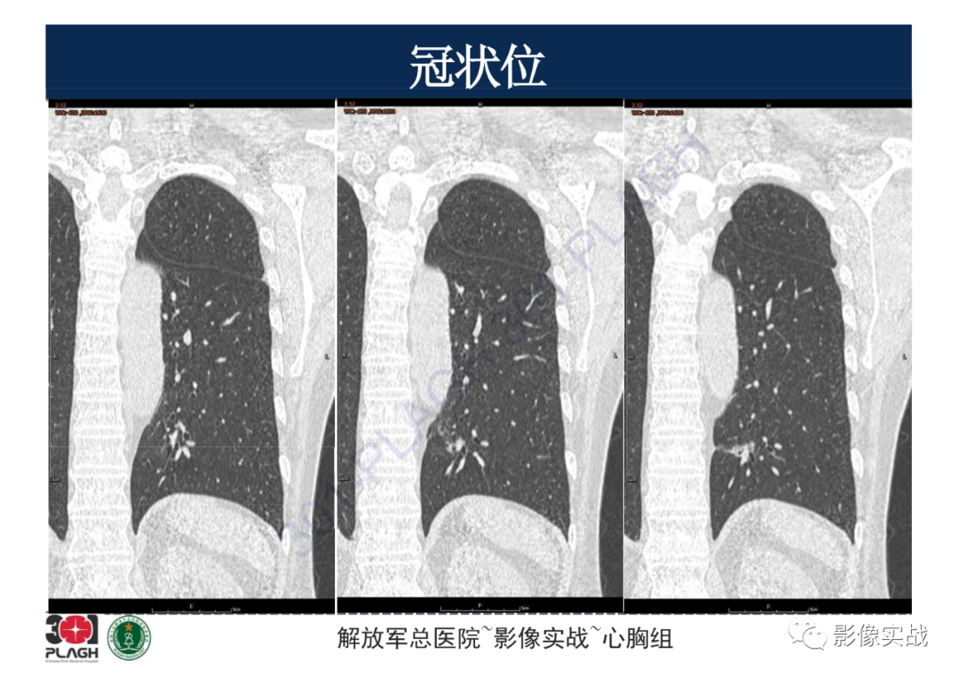 影像PPT - 【病例】肺浸润性腺癌1例CT影像-17