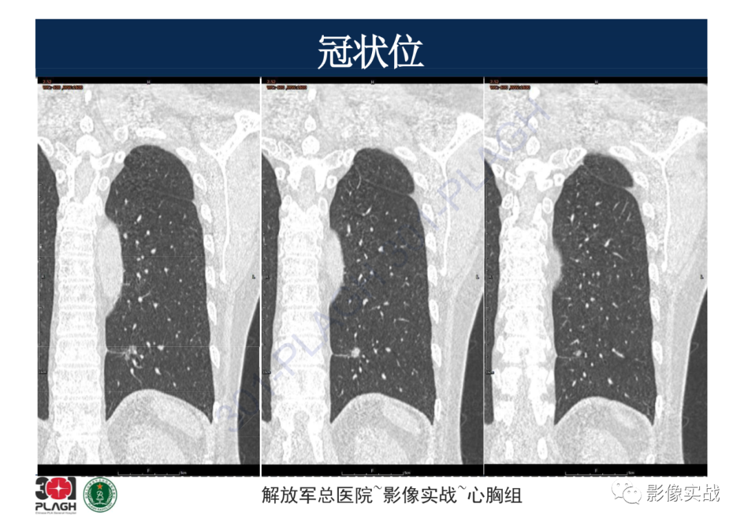 影像PPT - 【病例】肺浸润性腺癌1例CT影像-18