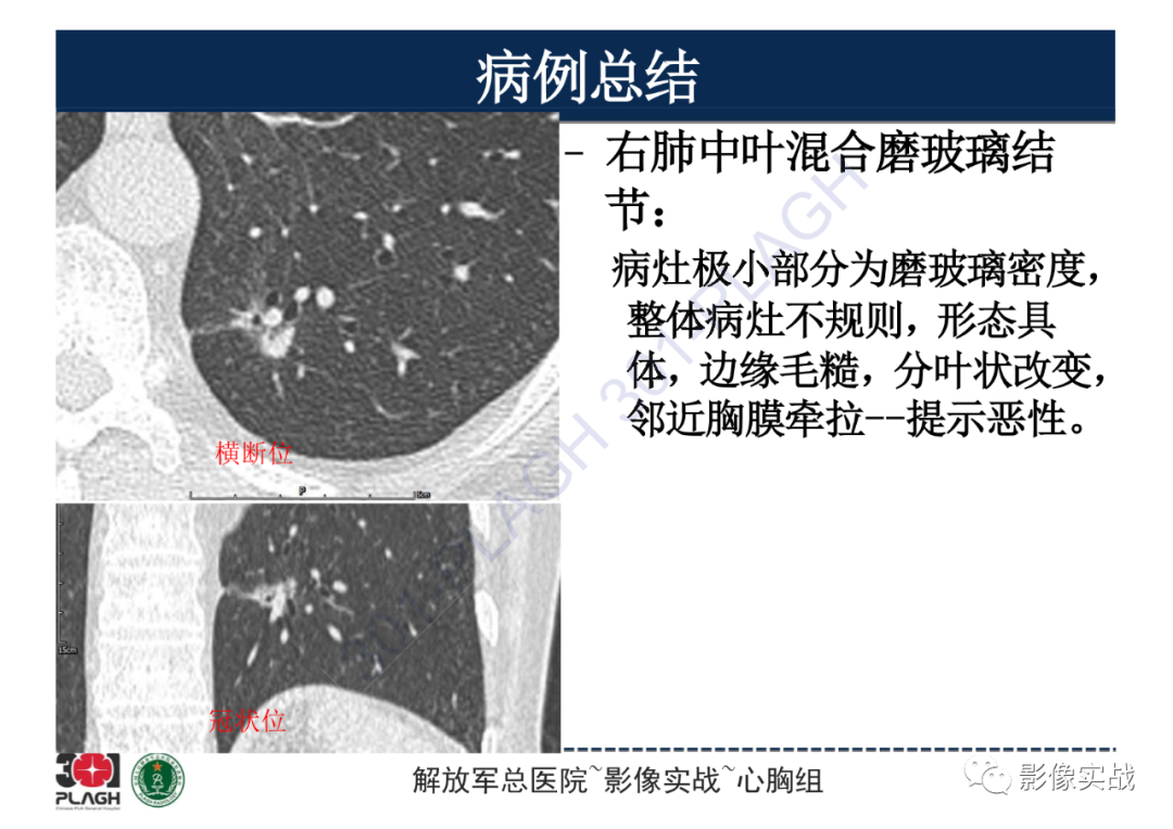 影像PPT - 【病例】肺浸润性腺癌1例CT影像-21