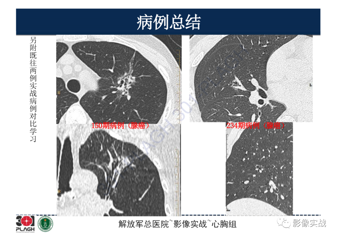 影像PPT - 【病例】肺浸润性腺癌1例CT影像-22