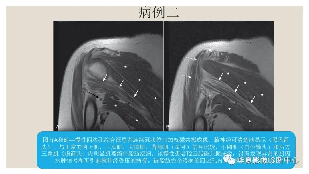影像PPT - 【PPT】四边孔综合征-9