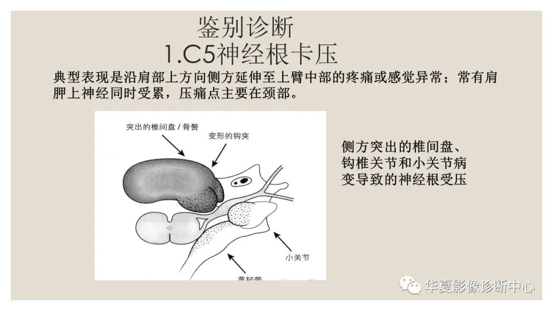 影像PPT - 【PPT】四边孔综合征-10