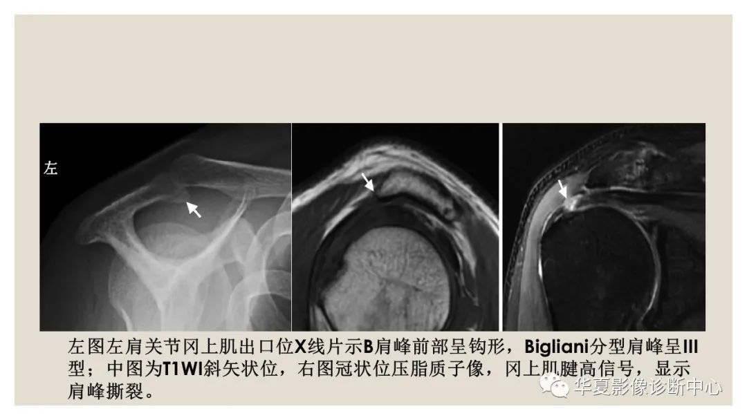 影像PPT - 【PPT】四边孔综合征-14