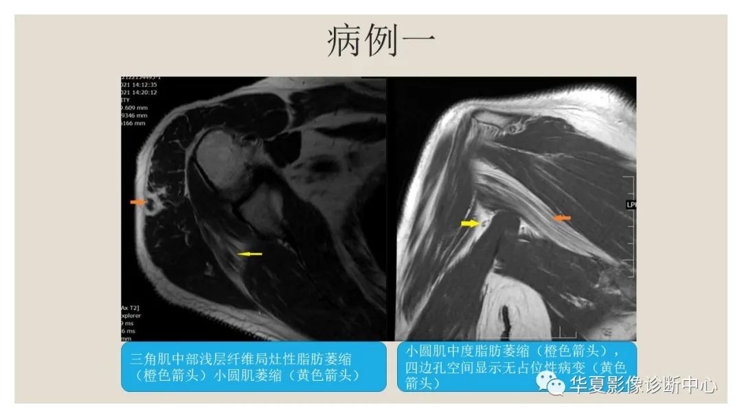 影像PPT - 【PPT】四边孔综合征-8