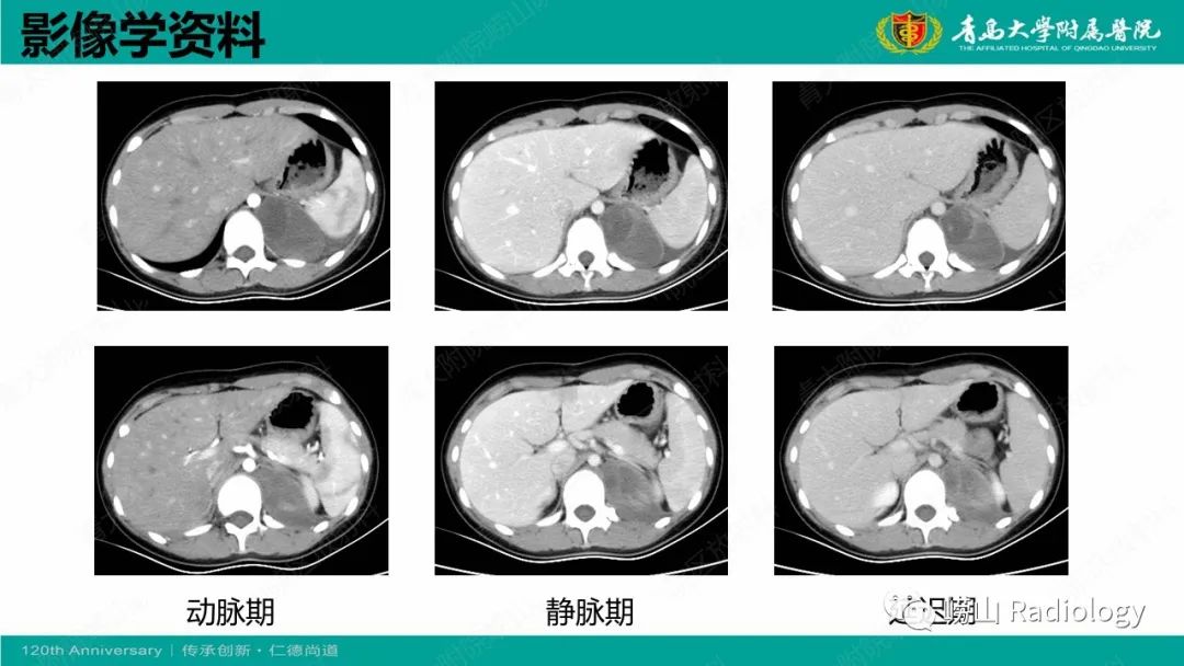 影像PPT - 【病例】纵隔节细胞神经母细胞瘤1例CT及MR-7