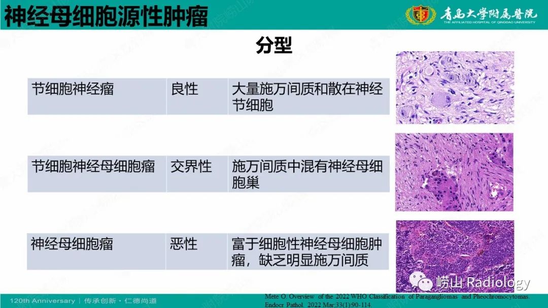 影像PPT - 【病例】纵隔节细胞神经母细胞瘤1例CT及MR-19