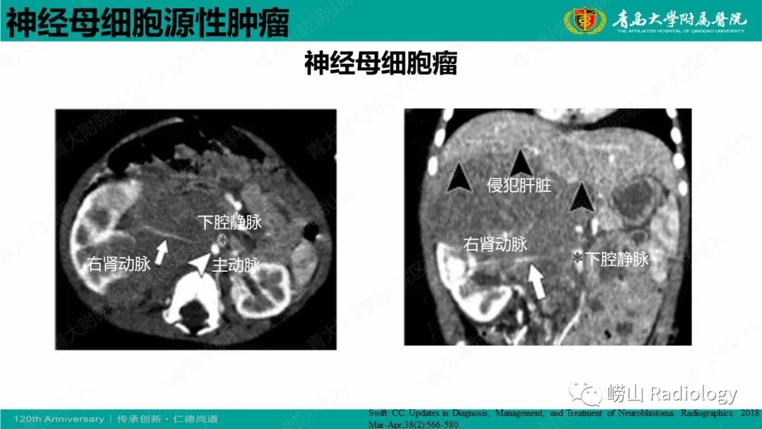 影像PPT - 【病例】纵隔节细胞神经母细胞瘤1例CT及MR-23