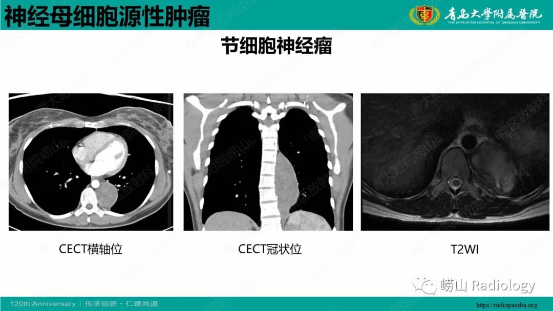 影像PPT - 【病例】纵隔节细胞神经母细胞瘤1例CT及MR-21