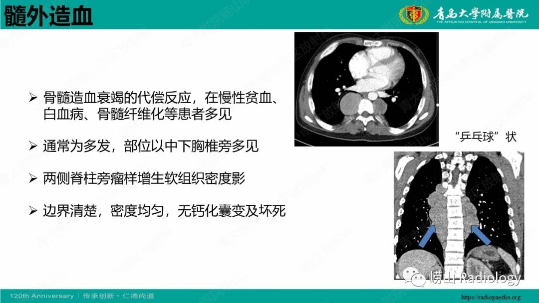 影像PPT - 【病例】纵隔节细胞神经母细胞瘤1例CT及MR-31