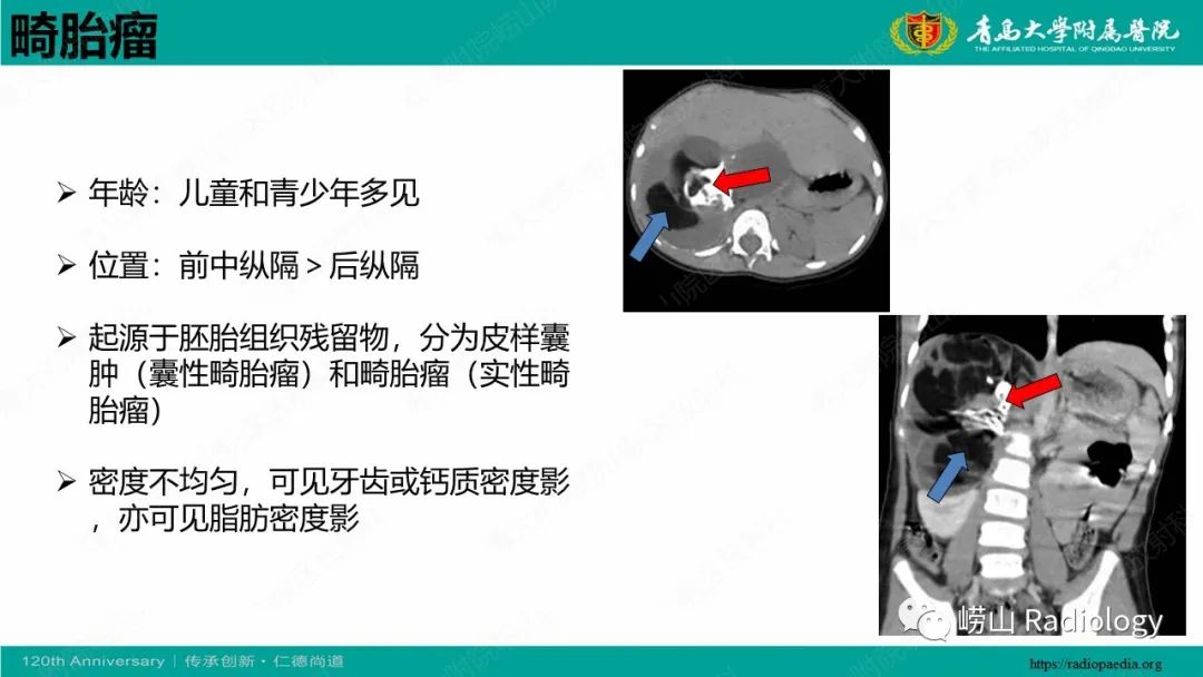 影像PPT - 【病例】纵隔节细胞神经母细胞瘤1例CT及MR-32