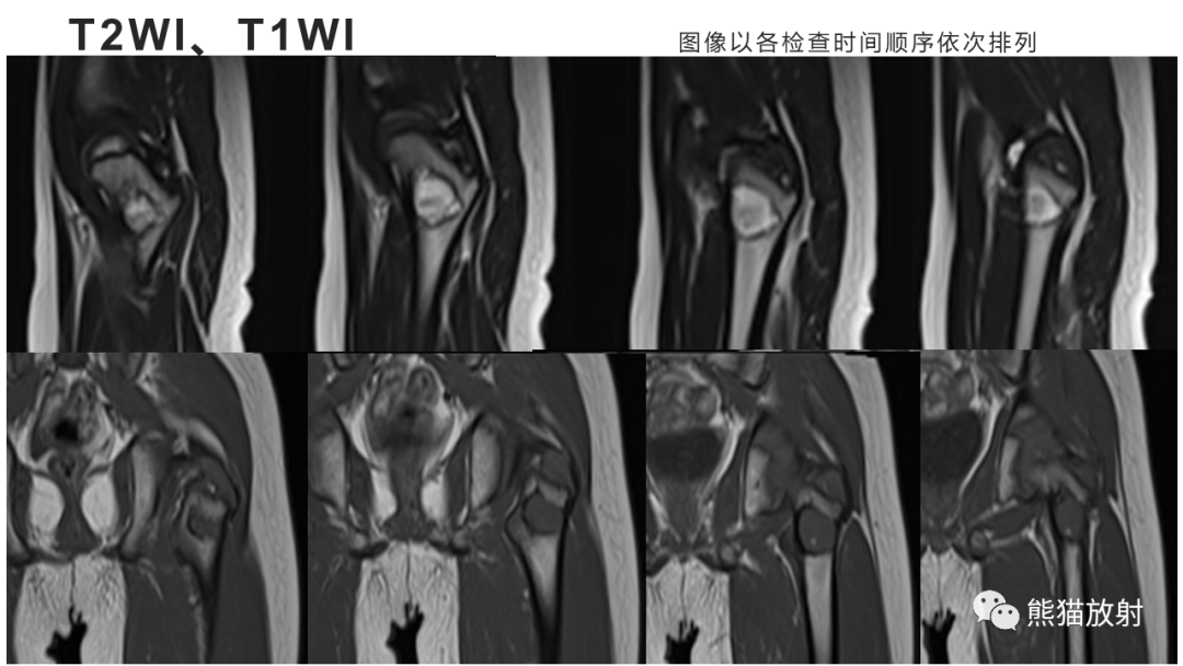 影像PPT - 【病例】长骨非骨化性纤维瘤2例X线CT及MR-4