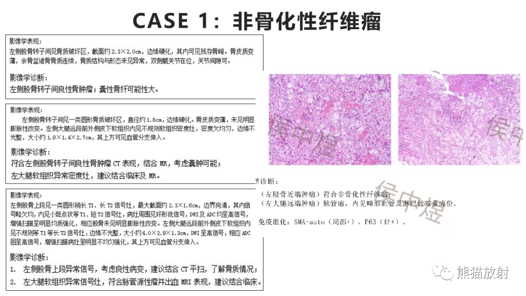 影像PPT - 【病例】长骨非骨化性纤维瘤2例X线CT及MR-23