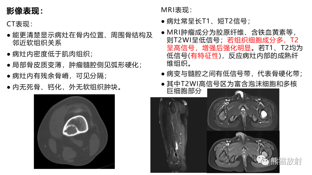影像PPT - 【病例】长骨非骨化性纤维瘤2例X线CT及MR-27