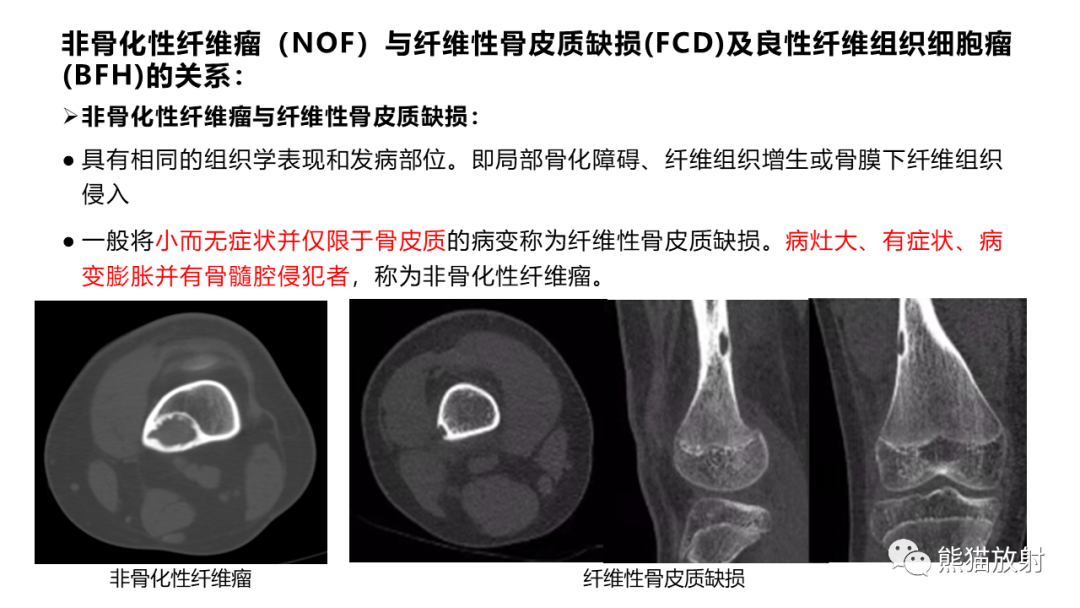 影像PPT - 【病例】长骨非骨化性纤维瘤2例X线CT及MR-30