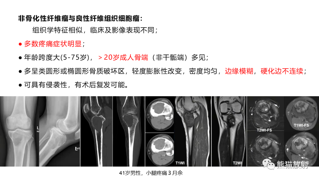 影像PPT - 【病例】长骨非骨化性纤维瘤2例X线CT及MR-31
