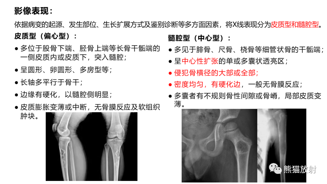 影像PPT - 【病例】长骨非骨化性纤维瘤2例X线CT及MR-26