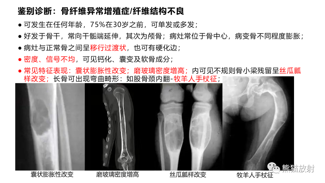 影像PPT - 【病例】长骨非骨化性纤维瘤2例X线CT及MR-33