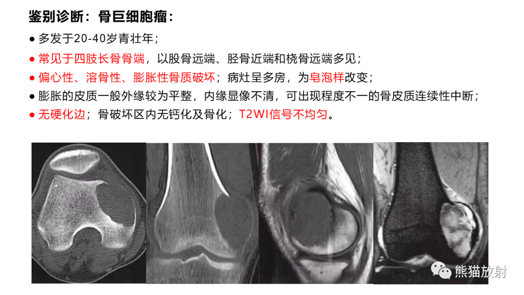 影像PPT - 【病例】长骨非骨化性纤维瘤2例X线CT及MR-34