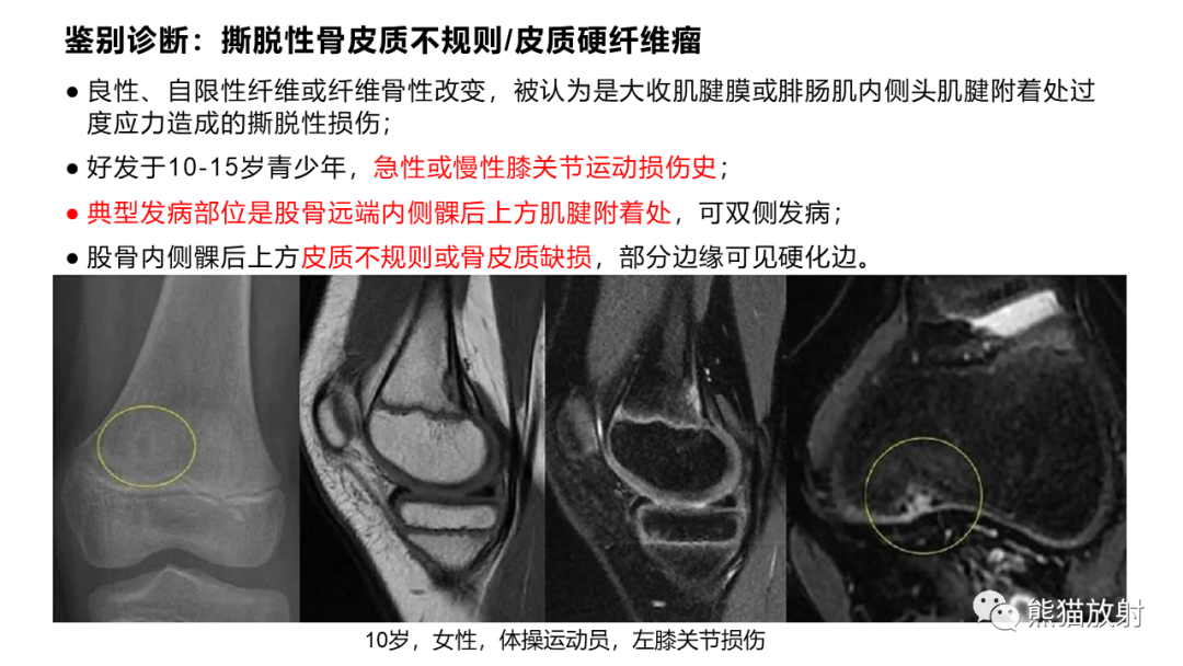 影像PPT - 【病例】长骨非骨化性纤维瘤2例X线CT及MR-36