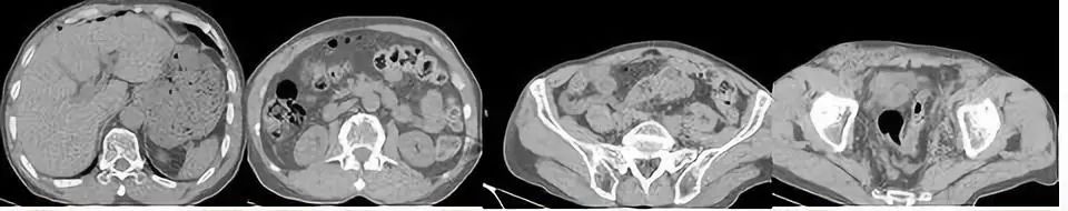 影像PPT - 【病例】气腹+压痛反跳痛+肌紧张,我误诊了…-8 影像PPT - 【病例】气腹+压痛反跳痛+肌紧张,我误诊了…-8