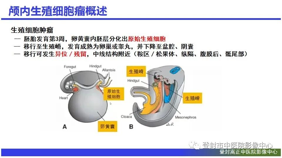 影像PPT - 【PPT】颅内生殖细胞瘤的影像学诊断-4