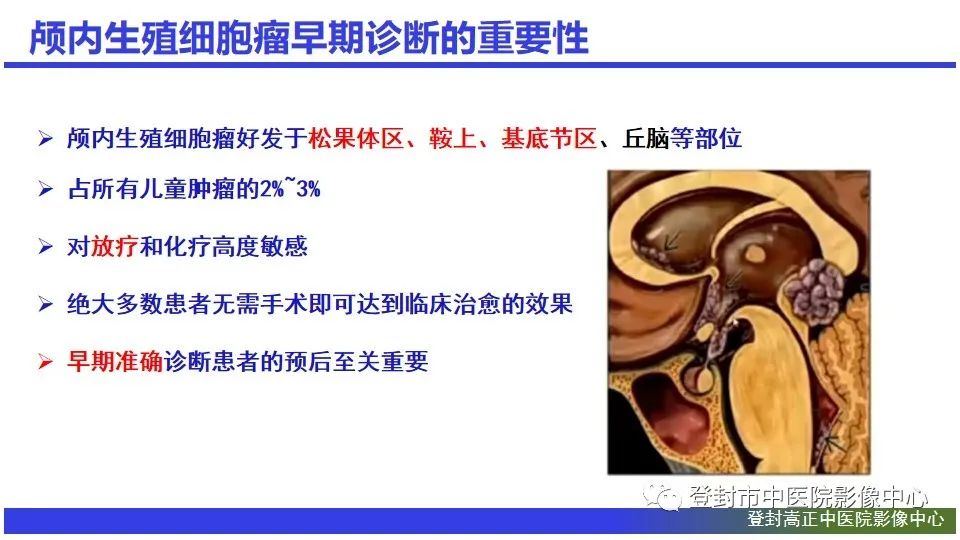 影像PPT - 【PPT】颅内生殖细胞瘤的影像学诊断-3