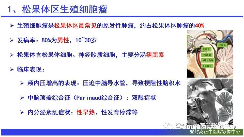 影像PPT - 【PPT】颅内生殖细胞瘤的影像学诊断-9