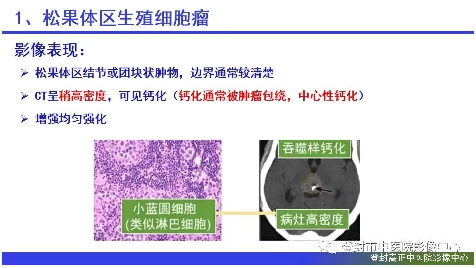 影像PPT - 【PPT】颅内生殖细胞瘤的影像学诊断-10