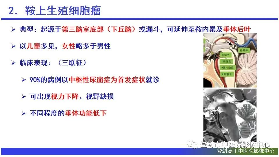 影像PPT - 【PPT】颅内生殖细胞瘤的影像学诊断-13