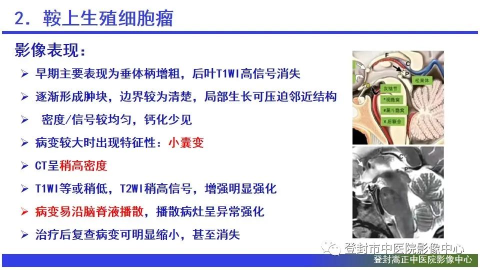 影像PPT - 【PPT】颅内生殖细胞瘤的影像学诊断-14
