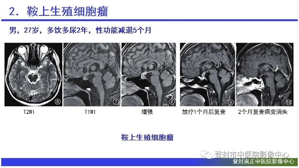 影像PPT - 【PPT】颅内生殖细胞瘤的影像学诊断-15