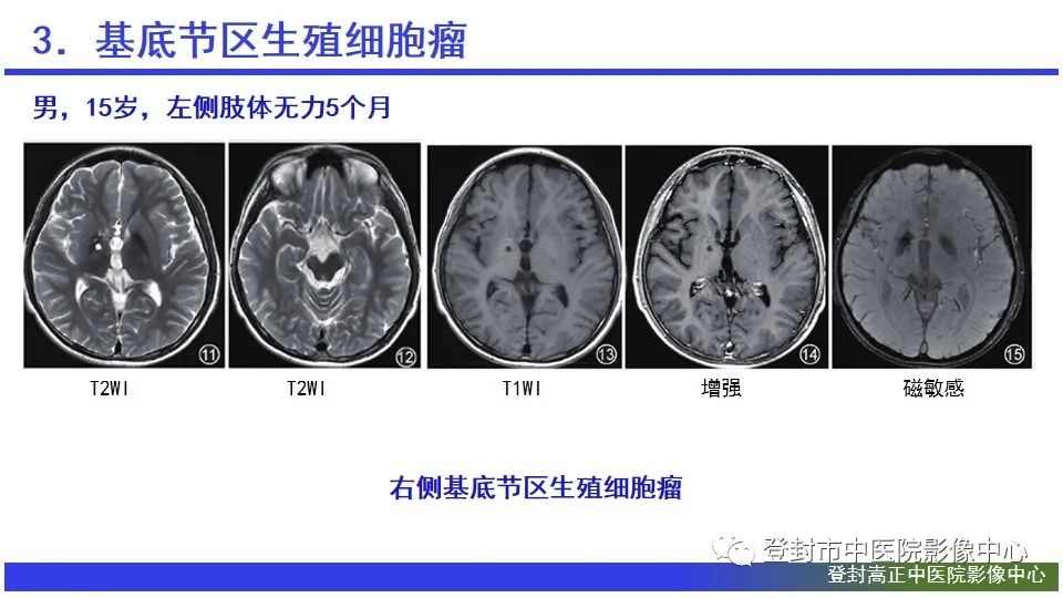 影像PPT - 【PPT】颅内生殖细胞瘤的影像学诊断-18