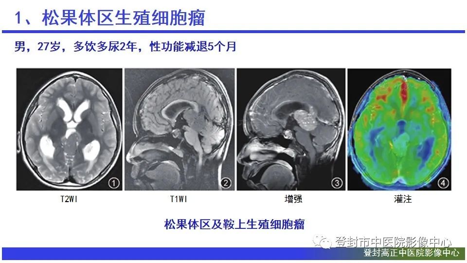 影像PPT - 【PPT】颅内生殖细胞瘤的影像学诊断-12