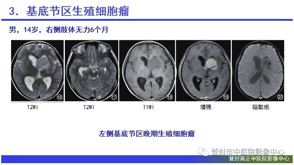 影像PPT - 【PPT】颅内生殖细胞瘤的影像学诊断-20