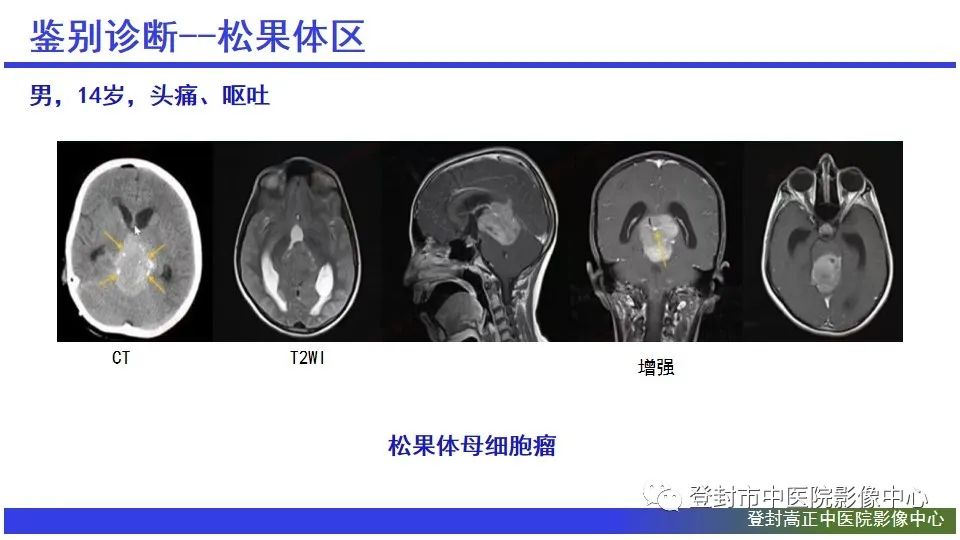 影像PPT - 【PPT】颅内生殖细胞瘤的影像学诊断-22