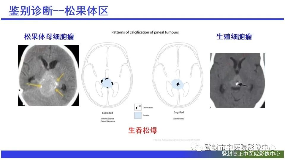 影像PPT - 【PPT】颅内生殖细胞瘤的影像学诊断-23
