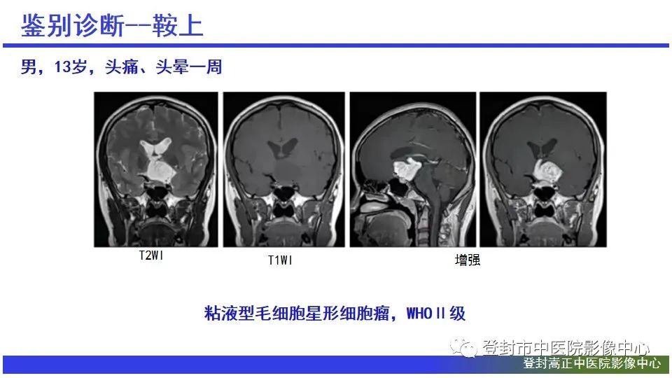 影像PPT - 【PPT】颅内生殖细胞瘤的影像学诊断-24