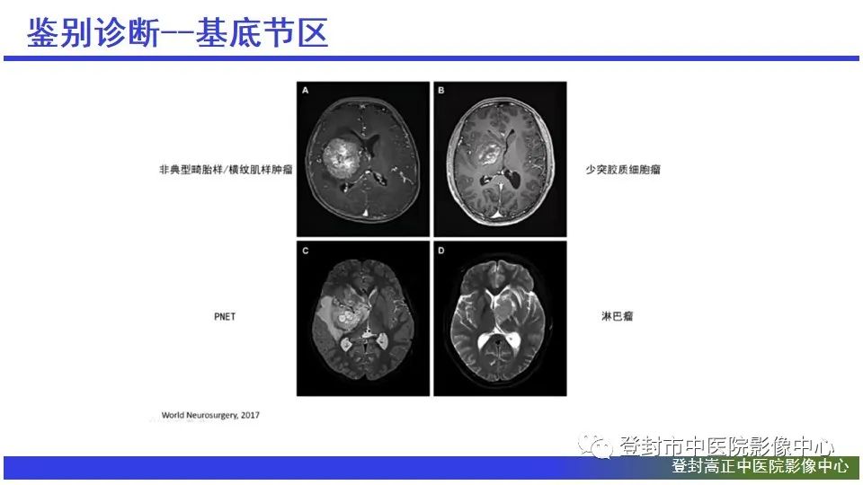 影像PPT - 【PPT】颅内生殖细胞瘤的影像学诊断-25