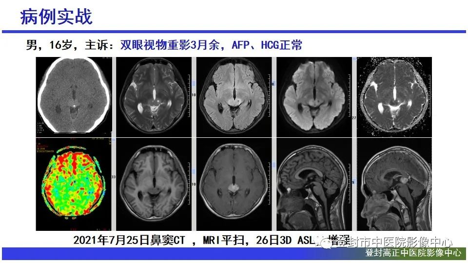 影像PPT - 【PPT】颅内生殖细胞瘤的影像学诊断-27