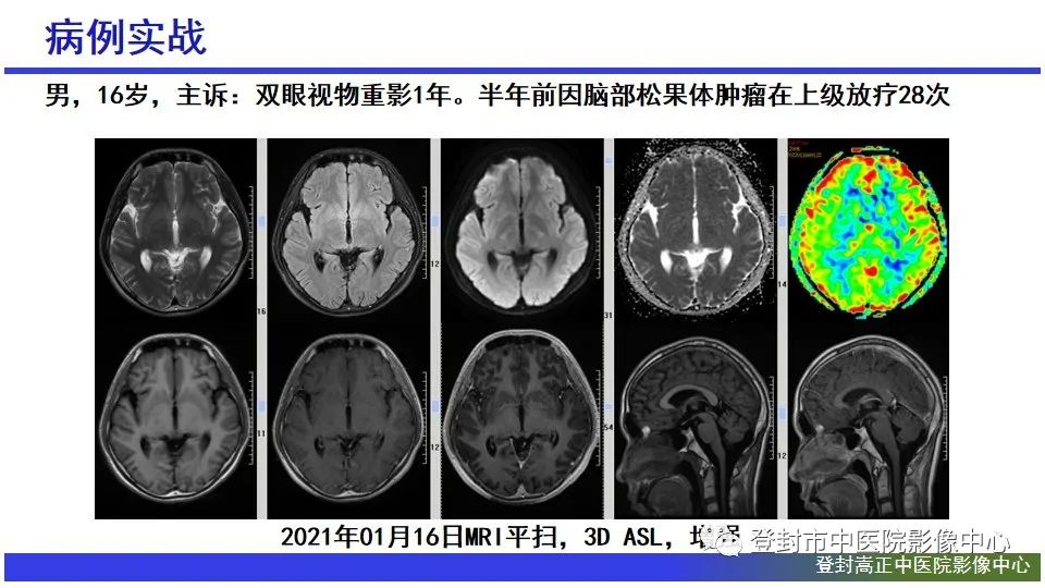 影像PPT - 【PPT】颅内生殖细胞瘤的影像学诊断-29