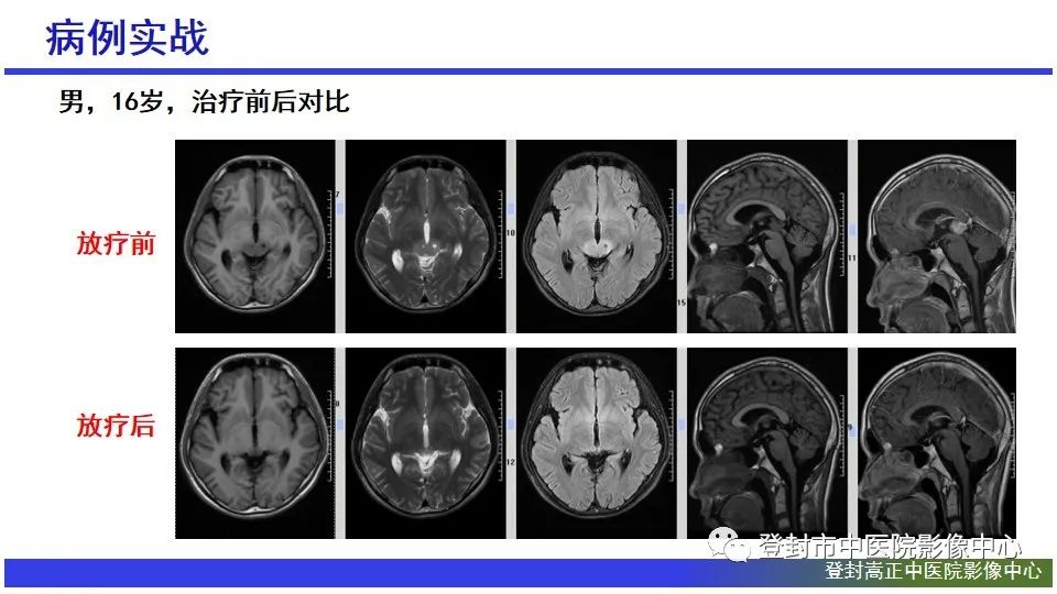 影像PPT - 【PPT】颅内生殖细胞瘤的影像学诊断-30