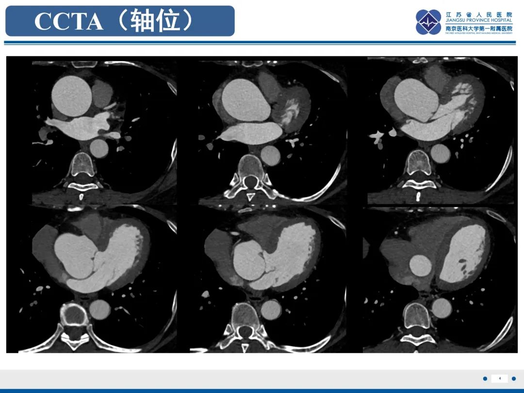 影像PPT - 【PPT】主动脉窦瘤-5