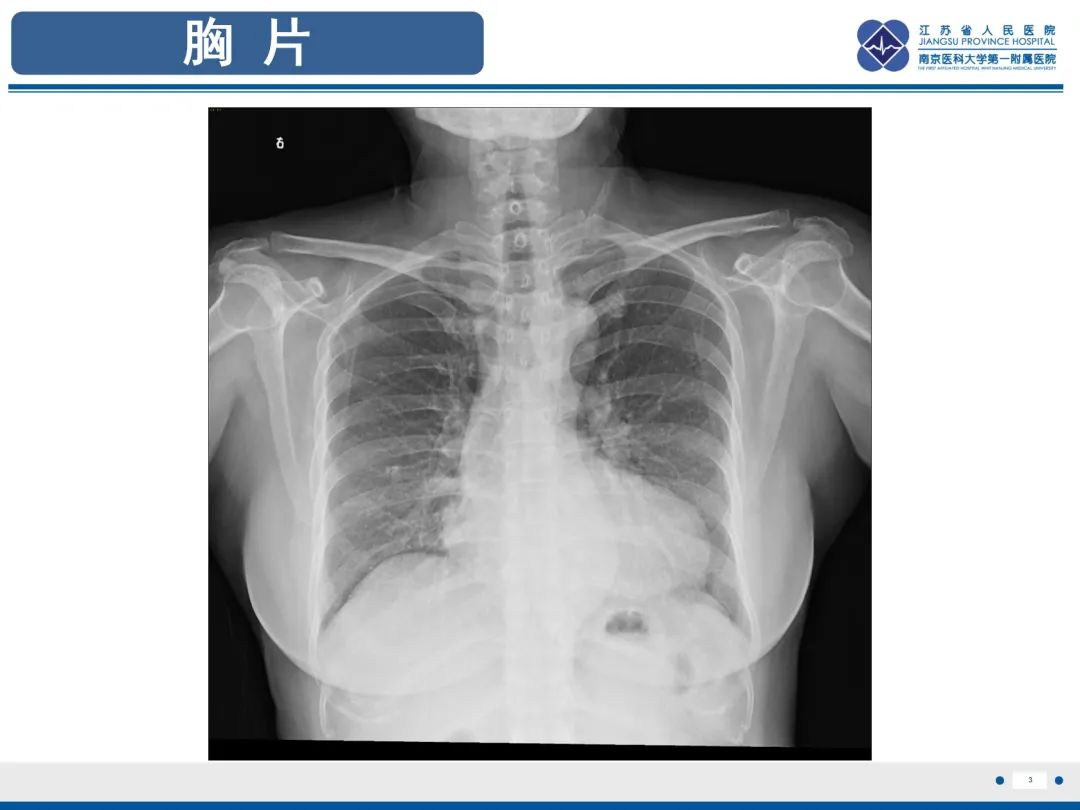 影像PPT - 【PPT】主动脉窦瘤-4