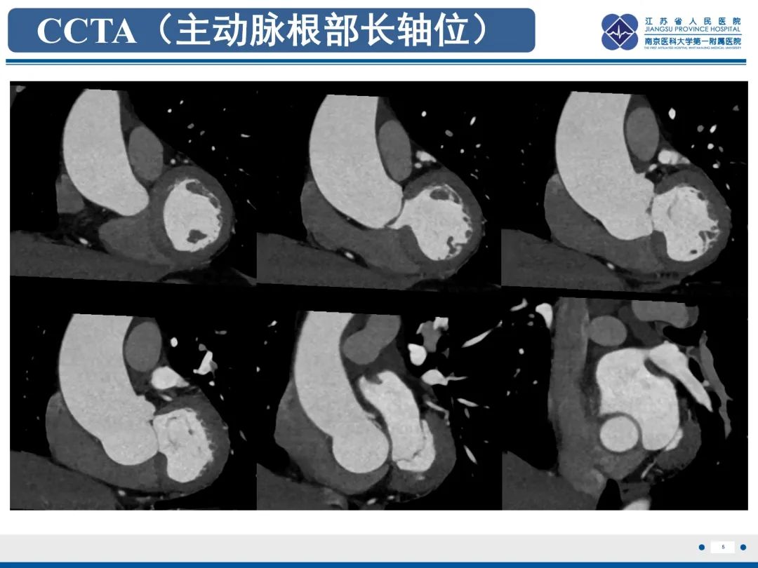 影像PPT - 【PPT】主动脉窦瘤-6