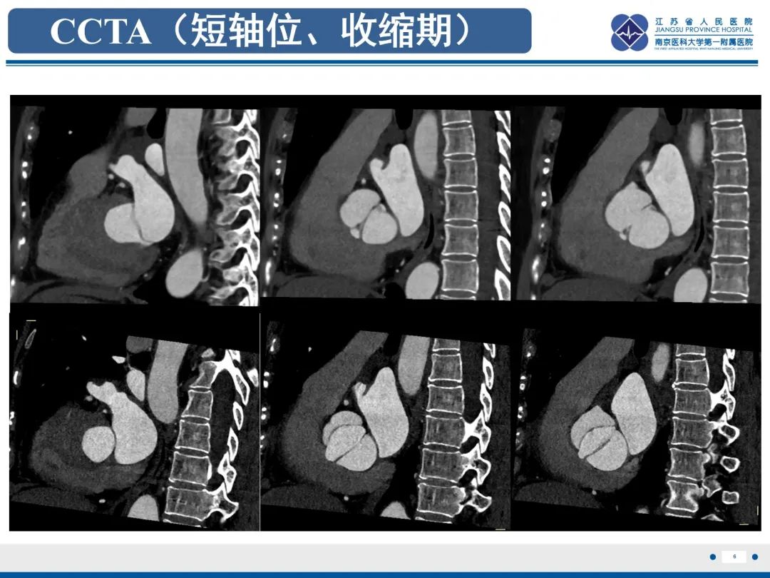 影像PPT - 【PPT】主动脉窦瘤-7