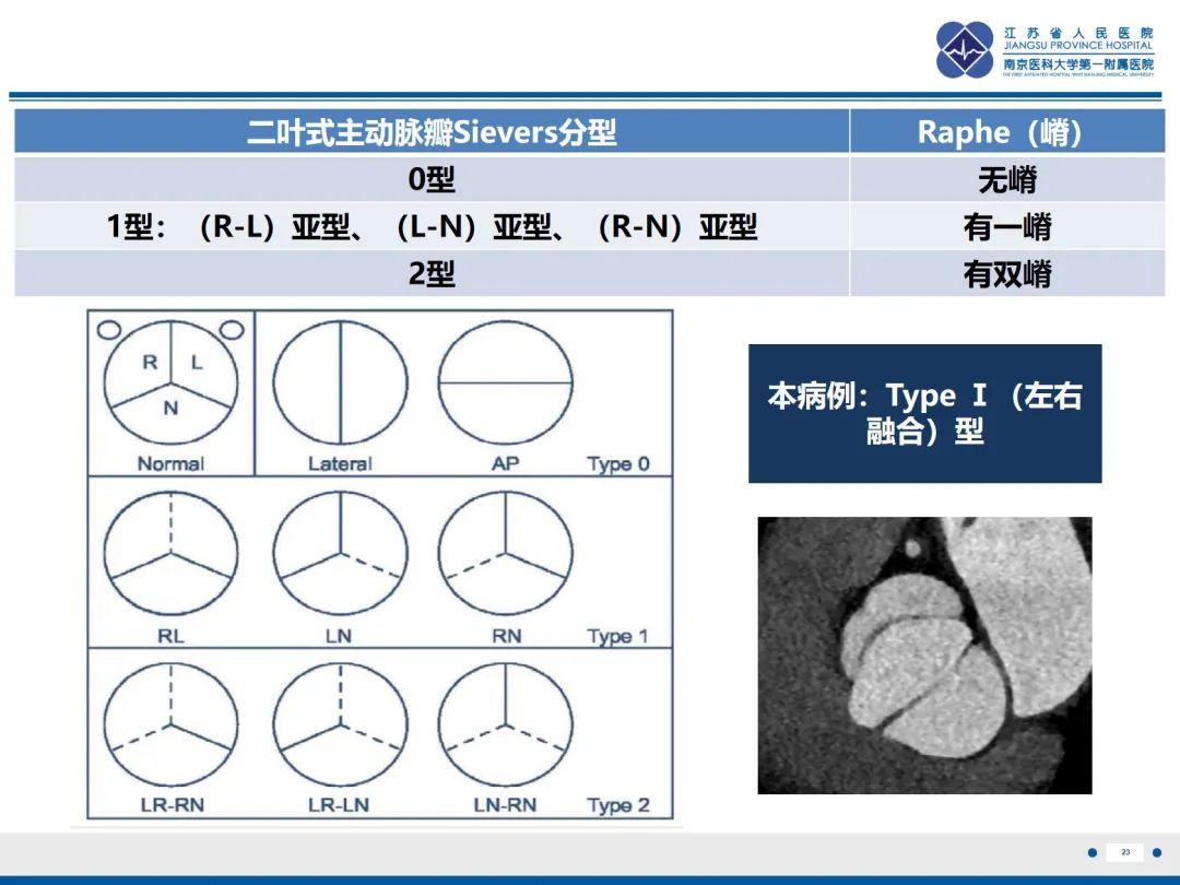 影像PPT - 【PPT】主动脉窦瘤-24