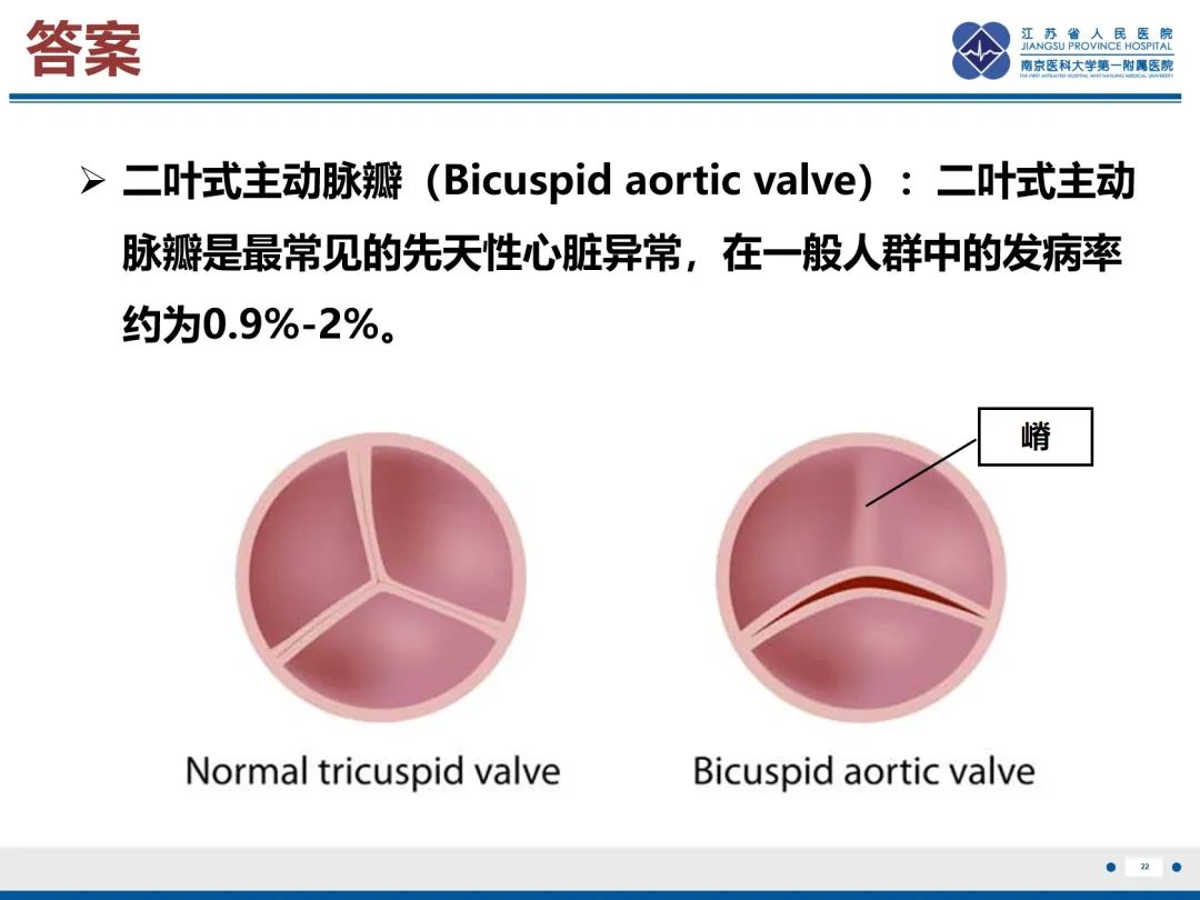 影像PPT - 【PPT】主动脉窦瘤-23
