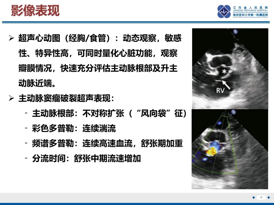 影像PPT - 【PPT】主动脉窦瘤-28